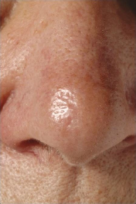 Morphoeic basal cell carcinoma on nasal tip | Open-i