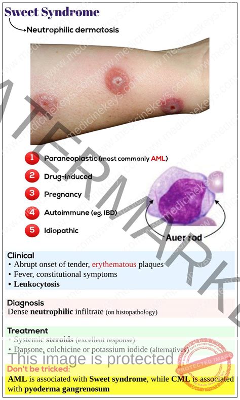 Sweet syndrome - Medicine Keys for MRCPs