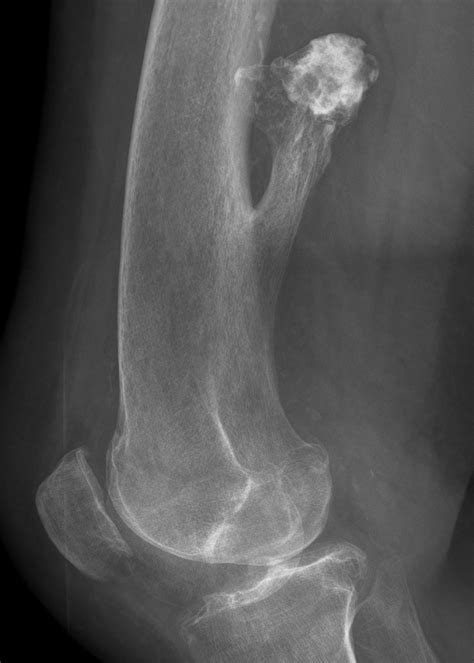 Osteochondroma Radiology - OrthopaedicsOne Images - OrthopaedicsOne