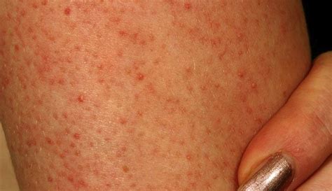 Keratosis Pilaris - Pictures, Symptoms, Causes, Treatment, Home Remedies