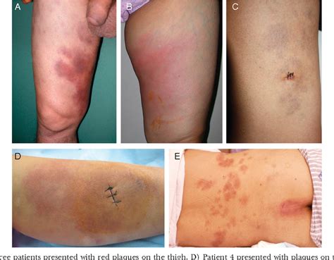 Figure 1 from Intravascular NK/T-cell lymphoma: a report of five cases ...