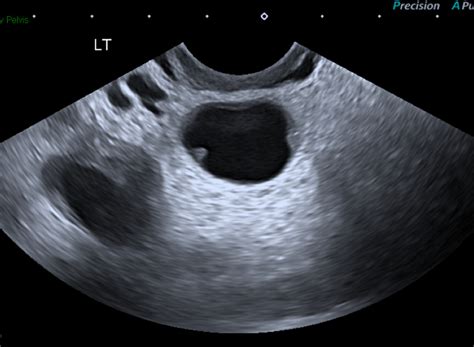 Tubo Ovarian Abscess On Ultrasound