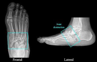 RadiologySpirit: Neuropathic Arthritis / Charcot Foot