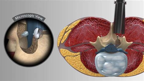 Minimally Invasive Laminotomies | Swift Institute