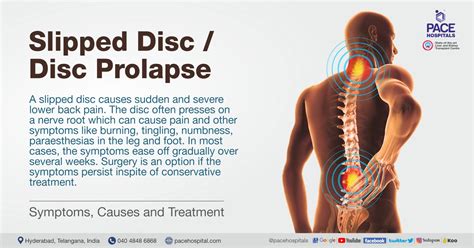 Slipped Disc Symptoms, Causes and Treatment | Disc Prolapse