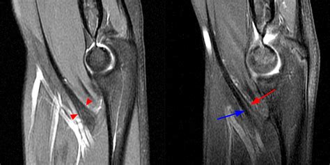 Distal Biceps Tendon Rupture Elbow - Radsource