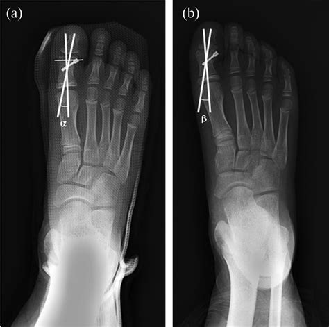 Proximal Phalanx Fracture Splint