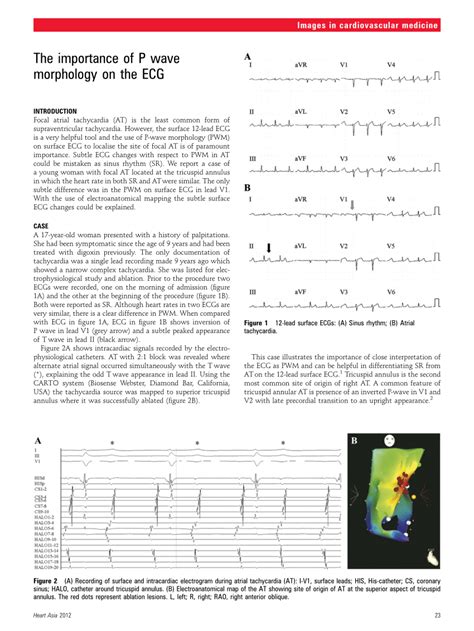 (PDF) The importance of P wave morphology on the ECG