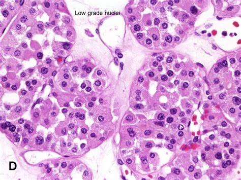 American Urological Association - Renal Oncocytoma