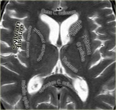 CT THALAMUS LEVEL ANATOMY