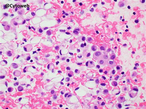 May 2020: A tricky pleural fluid | Cytoweb – Practical Cytopathology