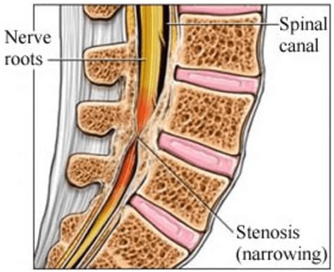 Spinal Stenosis Treatment in Fort Lauderdale & Delray Beach