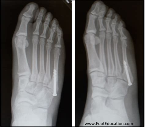 Jones Fracture - FootEducation