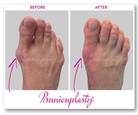 Before & After Photos of Bunion Surgery