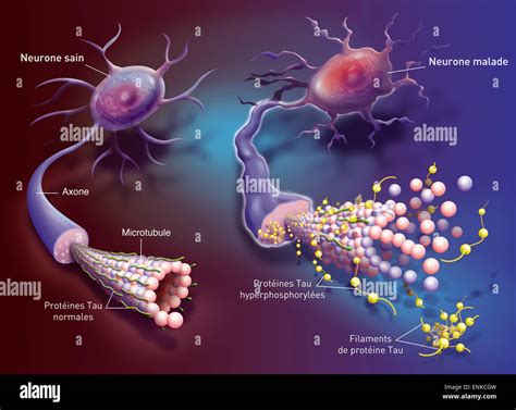 Neurofibrillary tangle hi-res stock photography and images - Alamy