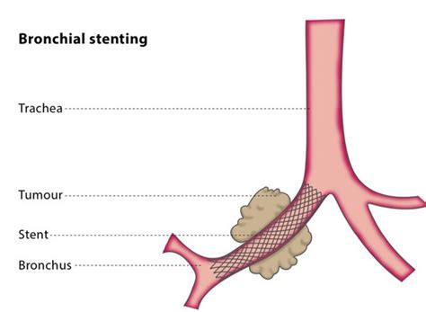 Endobronchial Stents | Pulmonary Associates