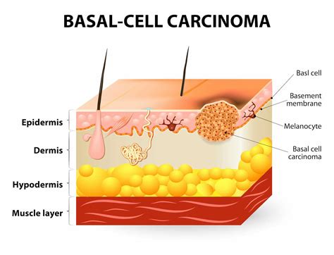 Sun damage and cancer: how UV radiation affects our skin