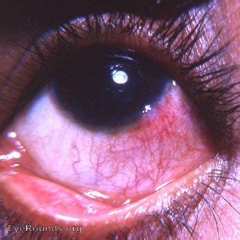 Phlyctenular keratoconjunctivitis. EyeRounds.org: Online Ophthalmic Atlas