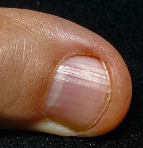 No half-moon on nails: What does it mean?