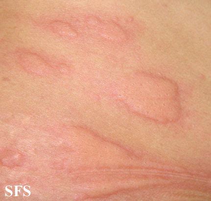 Drug Reaction Skin Rash and Medication Causing Skin Eruptions ...