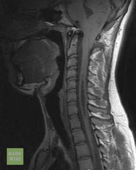 Arnold-Chiari malformation MRI - wikidoc