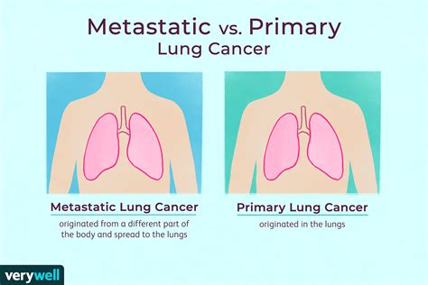 Metastatic Cancer to the Lungs: Symptoms and Treatment