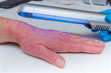 Phototherapy safe, effective for psoriasis