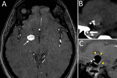 Brain Aneurysm Mri : 4 Intracranial Aneurysms Radiology Key - A brain ...