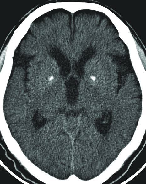 Calcifications in bilateral basal ganglia. | Download Scientific Diagram