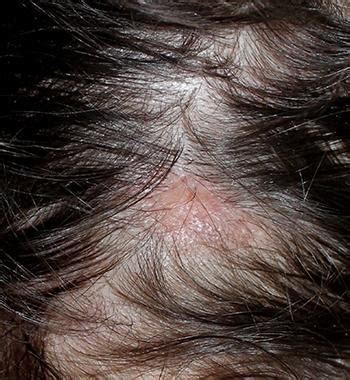 Scabs on Scalp: Everything You Need to Know - Wimpole Clinic