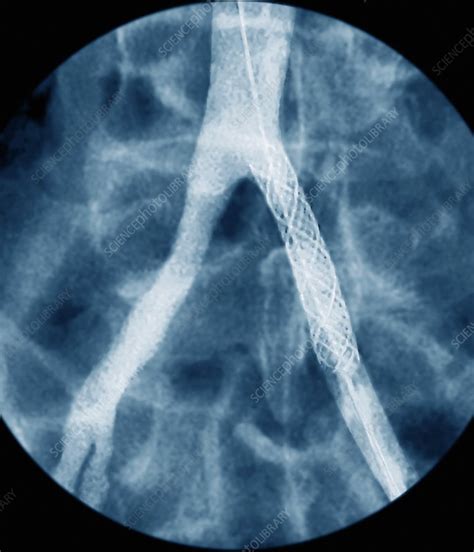 Stent in a narrowed artery, X-ray - Stock Image - M175/0359 - Science ...