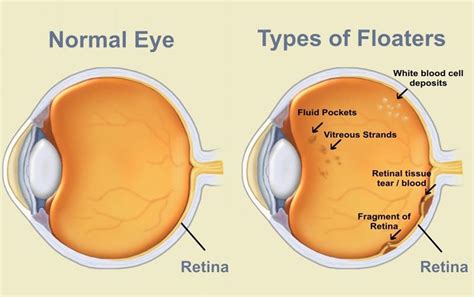 Eye Floaters, Black Eye Floaters and Eye Flashes - Causes and Treatment