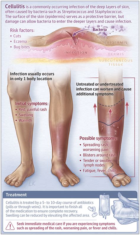 Cellulitis System Disorder Template