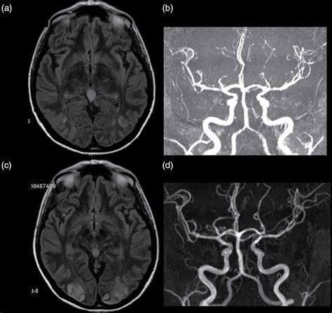 Cerebral vasculitis causes, symptoms, diagnosis, treatment & prognosis