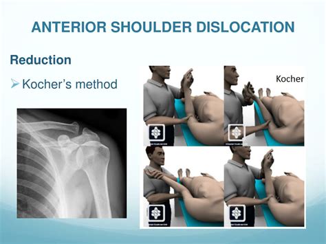 Anterior Shoulder Dislocation Reduction