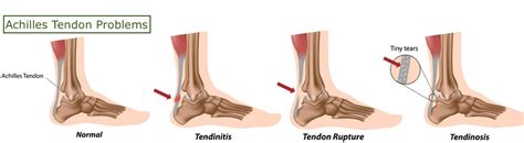 Ankle Pain: Causes and Treatments | Complete Pain Care