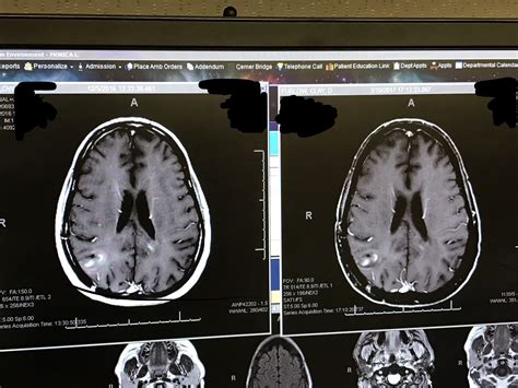 MRI Results