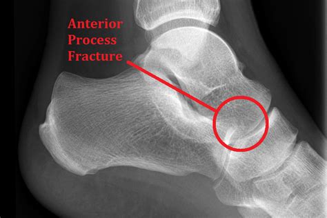 Anterior Process of the Calcaneus Avulsion Fracture - Ankle, Foot and ...