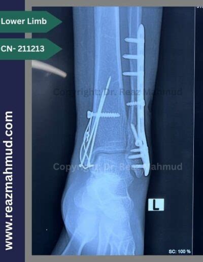 Bimalleolar Ankle Fracture | ORIF [CN-211213] - Dr. Reaz Mahmud