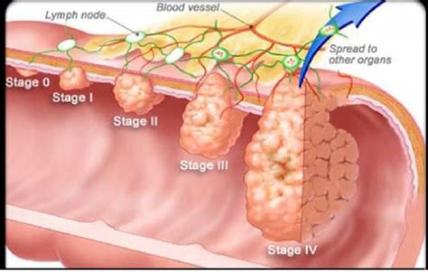 Clinical research on lower gastrointestinal cancer | CRUK CC