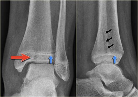 The Radiology Assistant : Special Ankle Fractures