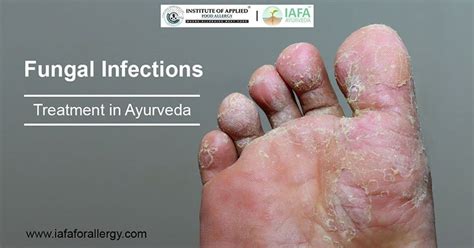 Fungal Infections Diagnosis And Treatment | ubicaciondepersonas.cdmx.gob.mx