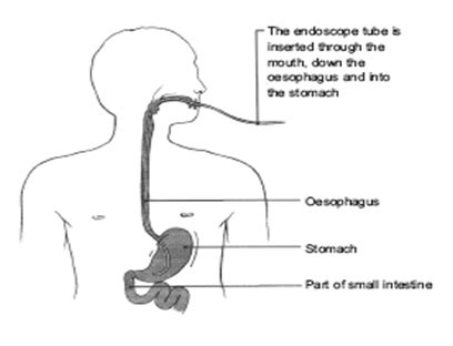 Colonoscopy after effects - friendsbilla