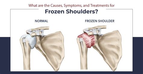 Causes, Symptoms, and Treatments for Frozen Shoulders