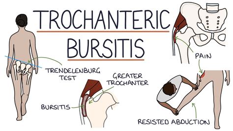 Understanding Trochanteric Bursitis - YouTube