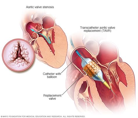 Aortic valve stenosis - Diagnosis and treatment - Mayo Clinic