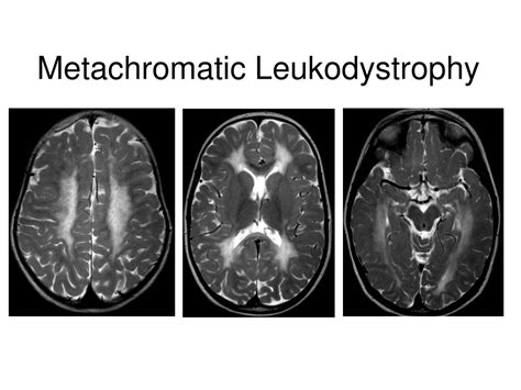 PPT - Leukodystrophy PowerPoint Presentation, free download - ID:3337515