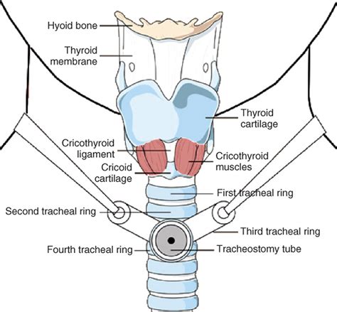 Tracheostomy - Procedure, Care, Tracheostomy Complications