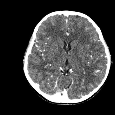 Normal CT brain with contrast: paediatric | Radiology Case ...