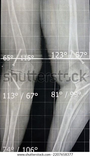 Plain X Ray Long Film Standing Stock Photo 2207658377 | Shutterstock